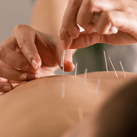 Accupuncture